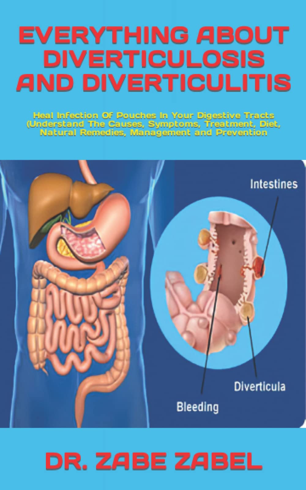 Buy EVERYTHING ABOUT DIVERTICULOSIS AND DIVERTICULITIS Heal Infection