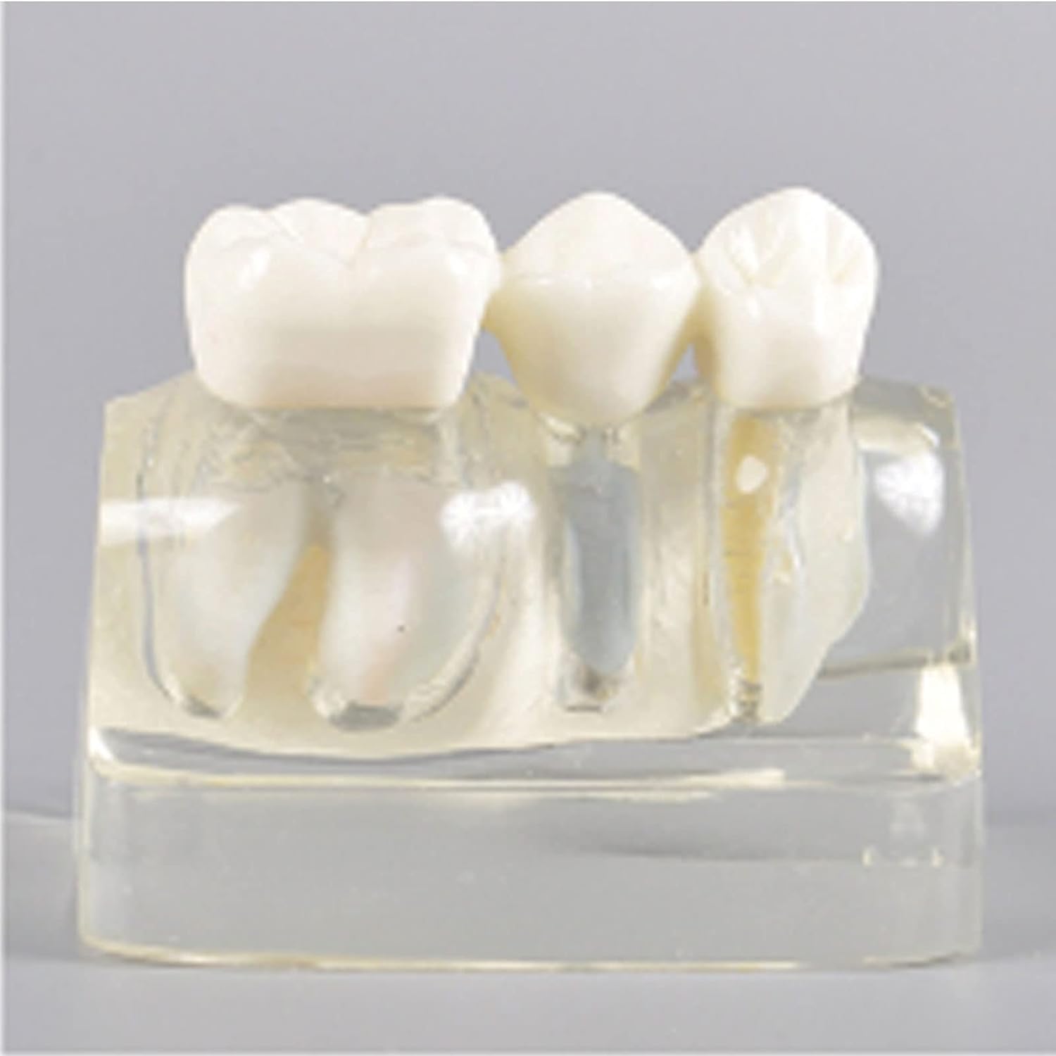 Modello Dentale di Dentista, Modello di impianto Dentale, Materiale in Resina Rimovibile utilizzato per la Ricerca in Clinica odontoiatrica e per la Comunicazione Medico-paziente.
