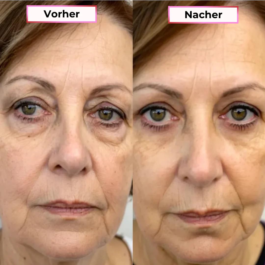 GlowEyes Pro - 2-in-1 Rotlichttherapie + EMS zur Beseitigung von Augenringen Augenmassagegerät mit Rotlichttherapie Reduziert Schwellungen und Falten um die Augen