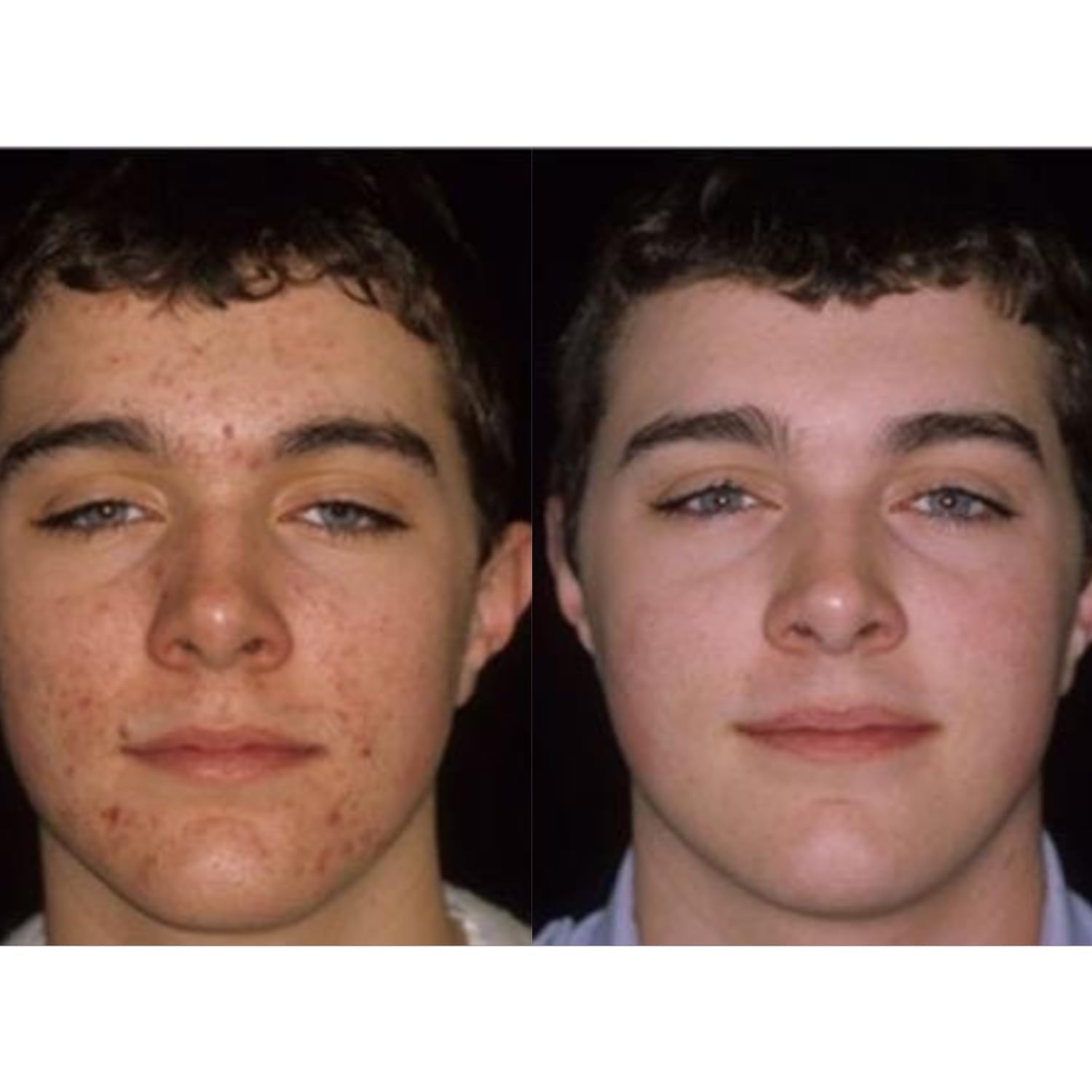 Acnetame Acne Pills 60- Supplements for Acne Treatment Pill Women Men Teens — Amazon image 4