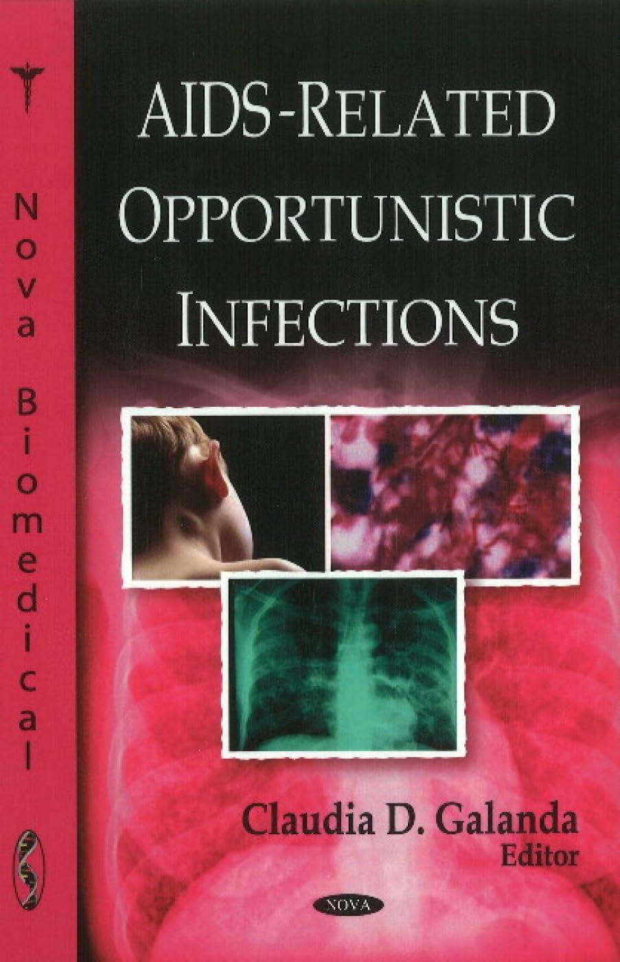 Buy AIDS-Related Opportunistic Infections — BookShops.in