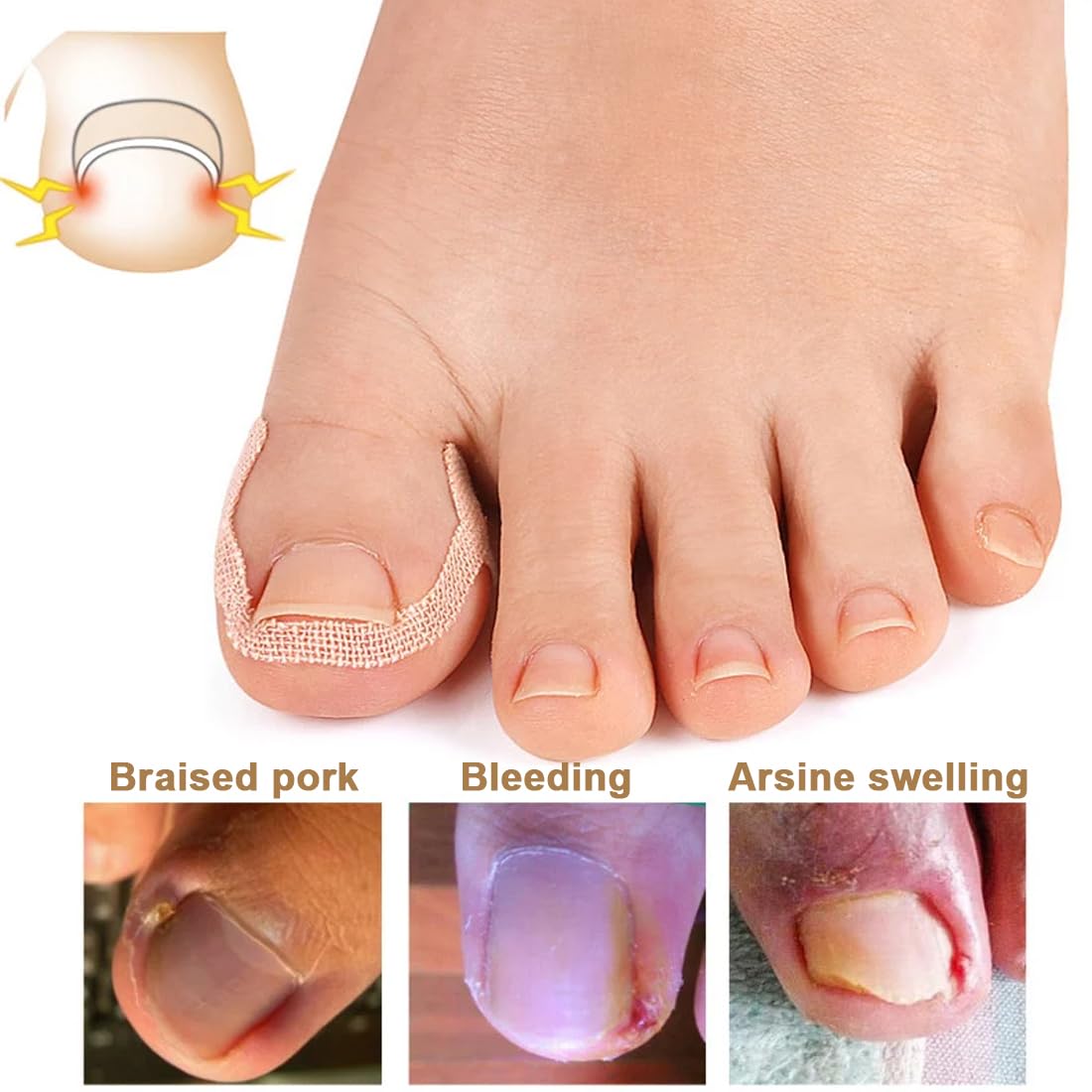 Set di unghie Incarneato, Correttore Unghie Incarnite Piedi, Soluzione Completa per Unghie dei Piedi Incarnite, Traspiranti Cerotti Per Unghie, Cuscinetti Di C Per Unghie Incarnite Piedi