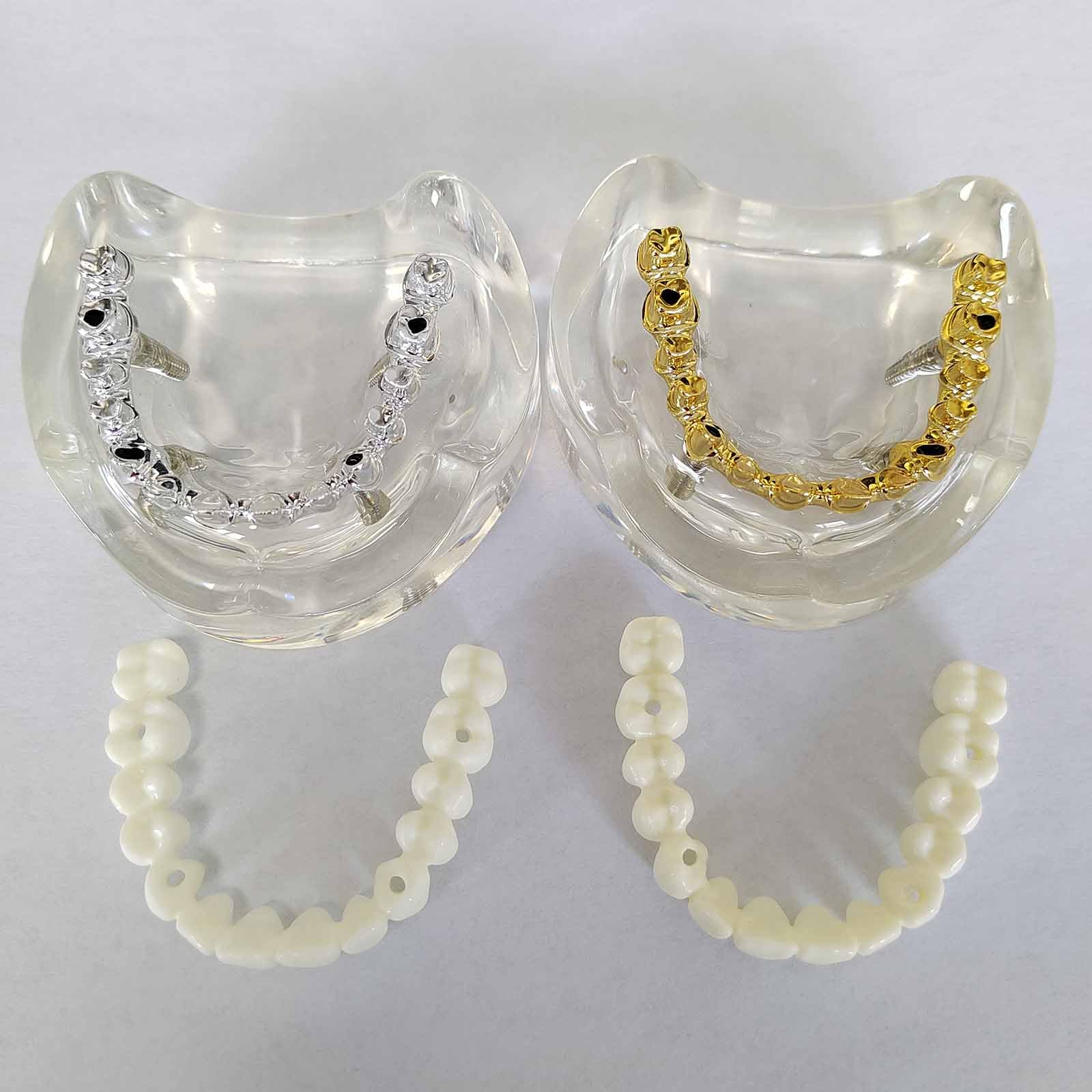 Modèle d'overdenture Modèle de typodont Dentaire Modèle d'implant pour la Recherche, l'enseignement et l'étude en médecine Dentaire