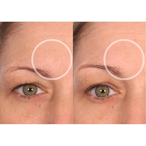 Miniatura 5 de SiO Beauty BrowLift - Parche antiarrugas para la frente, suavizado de línea de expresión, silicona de grado médico para reducción de arrugas durante