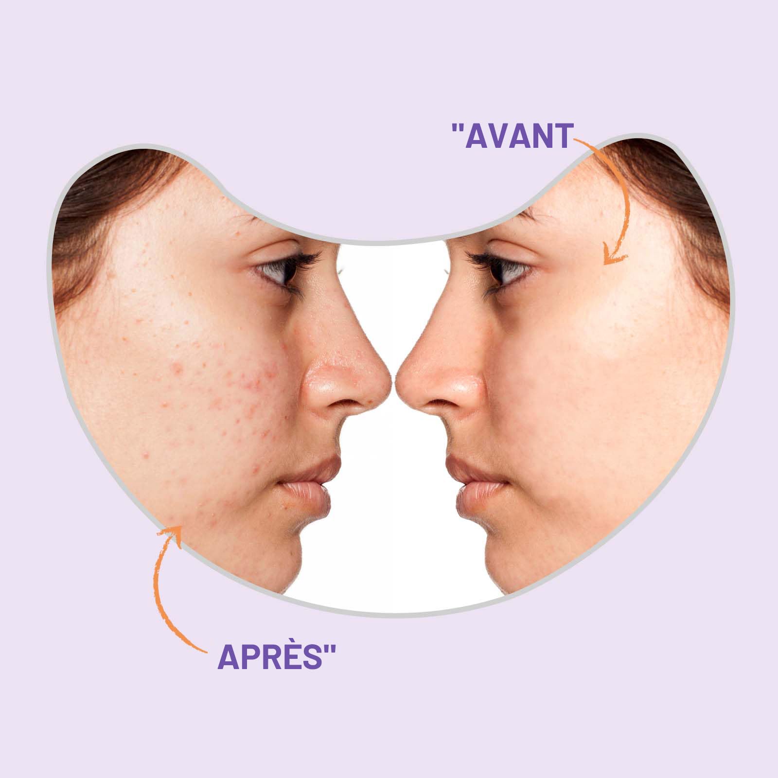 Patchs bouton ACOTYE 32pcs, pimple patch à L'huile d'arbre à thé, acide salicylique à et niacinamide, pour sur le menton, les joues, le dos