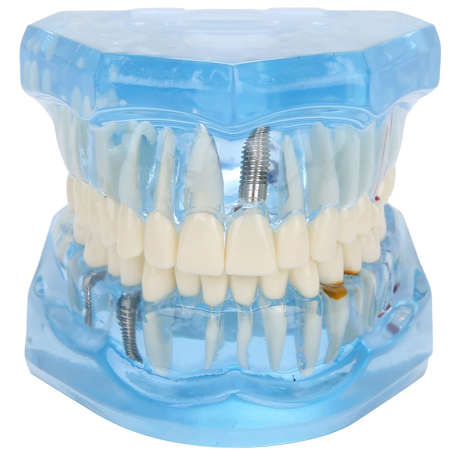 Dentier Modèle D'enseignement, Bleus En Acrylique Transparent Modèle Dentaire, Prothese Dentaire Amovible, Modèle Pathologique pour l'étude et l'éducation