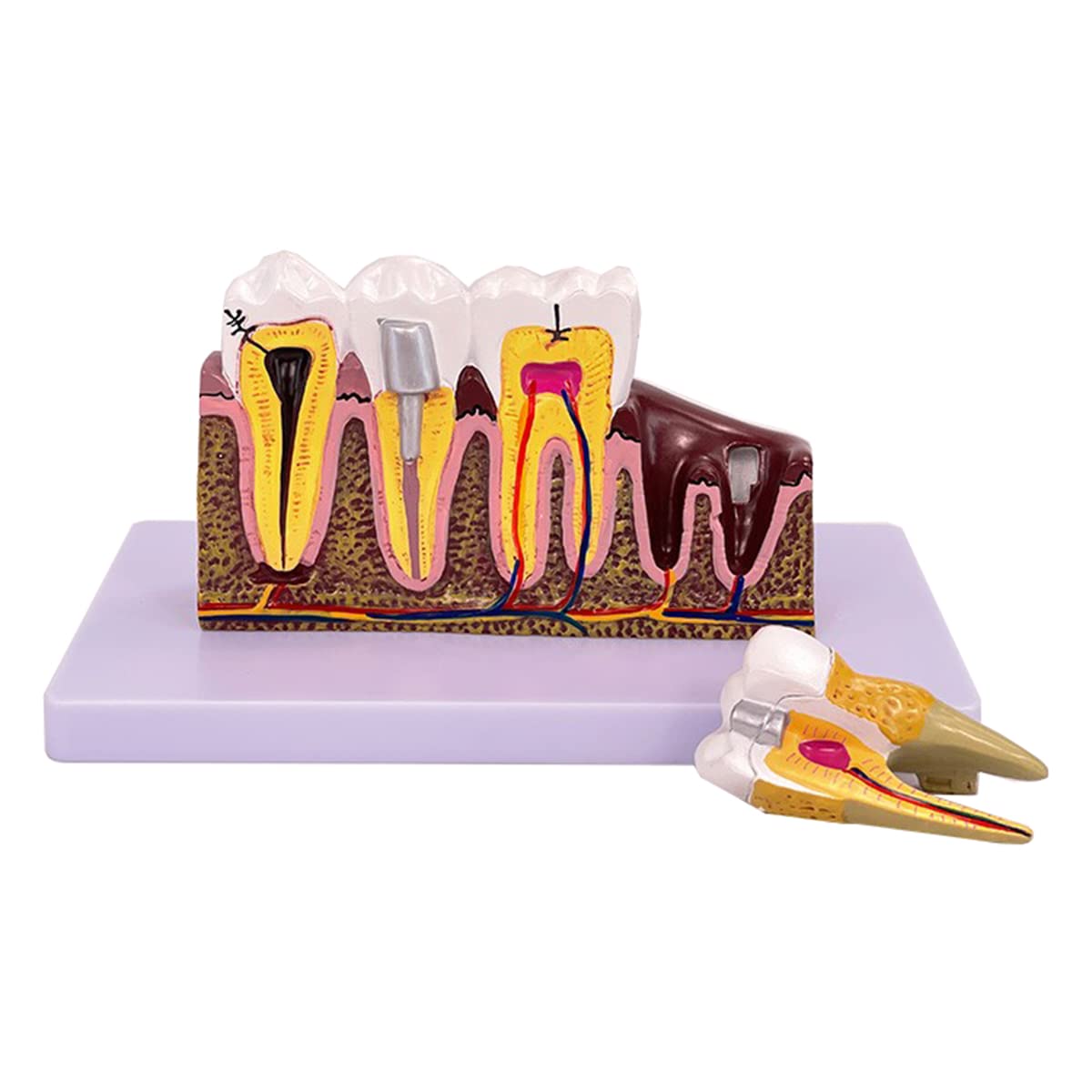 sjdoPulse Tooth Model, 10X Anatomical Lower Molar Model Simulated Oral Tooth Teeth Demonstration Model with Caries for Study Teaching