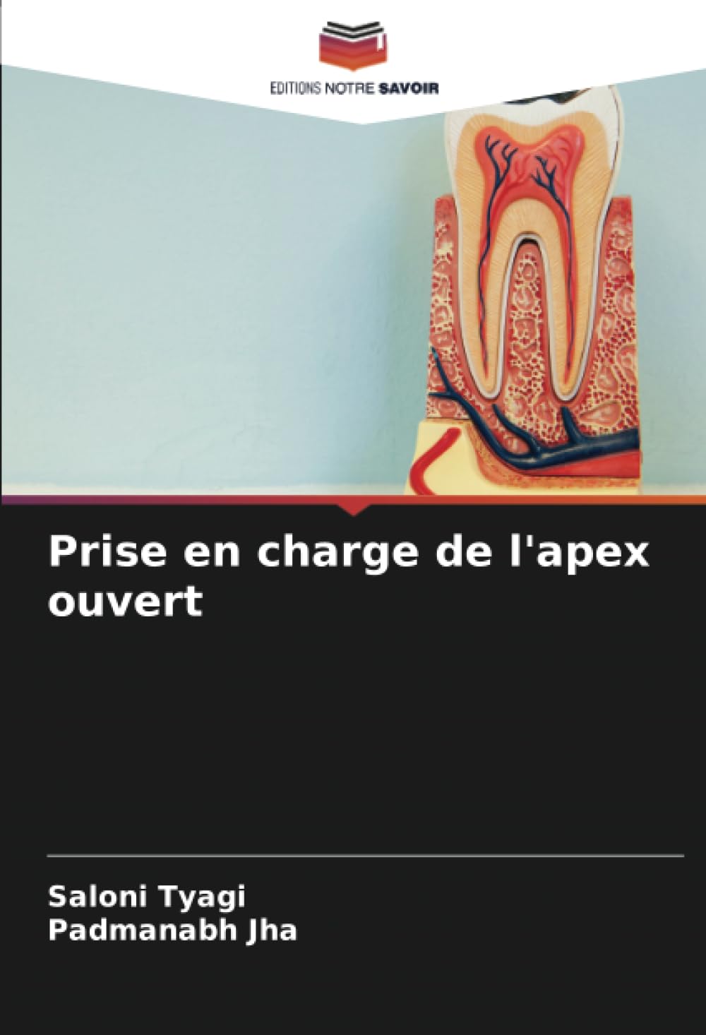 Prise en charge de l'apex ouvert