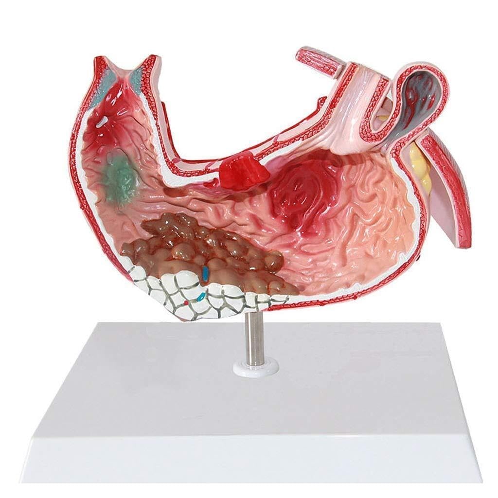 XINGLUOY Human organ anatomy model - human stomach gastritis gastric lesion