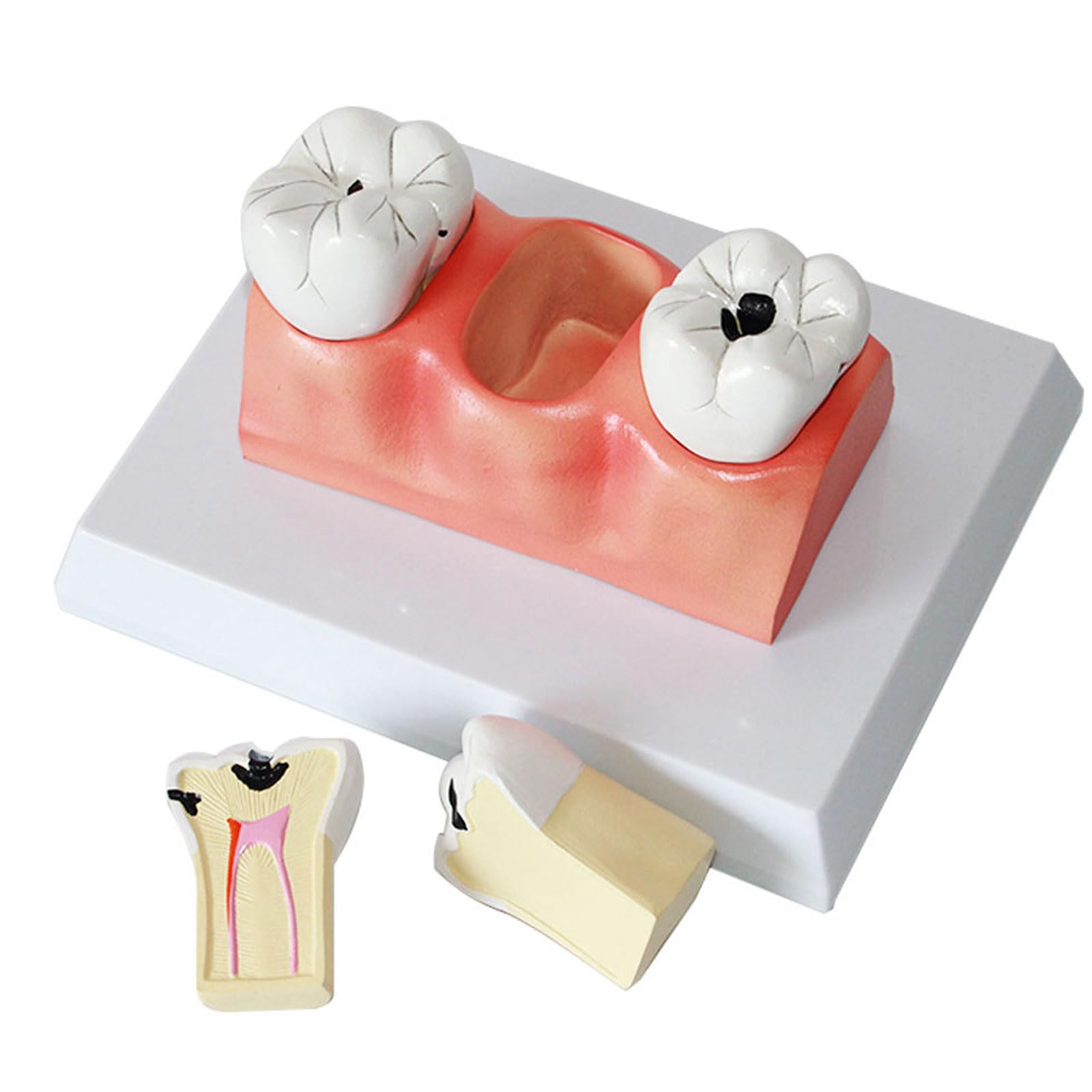 Modelli di comparazione della Carie 4 Volte Modello di decomposizione della Carie Denti sezionati Modello per la Ricerca didattica Modello di Studio per Studenti di odontoiatria