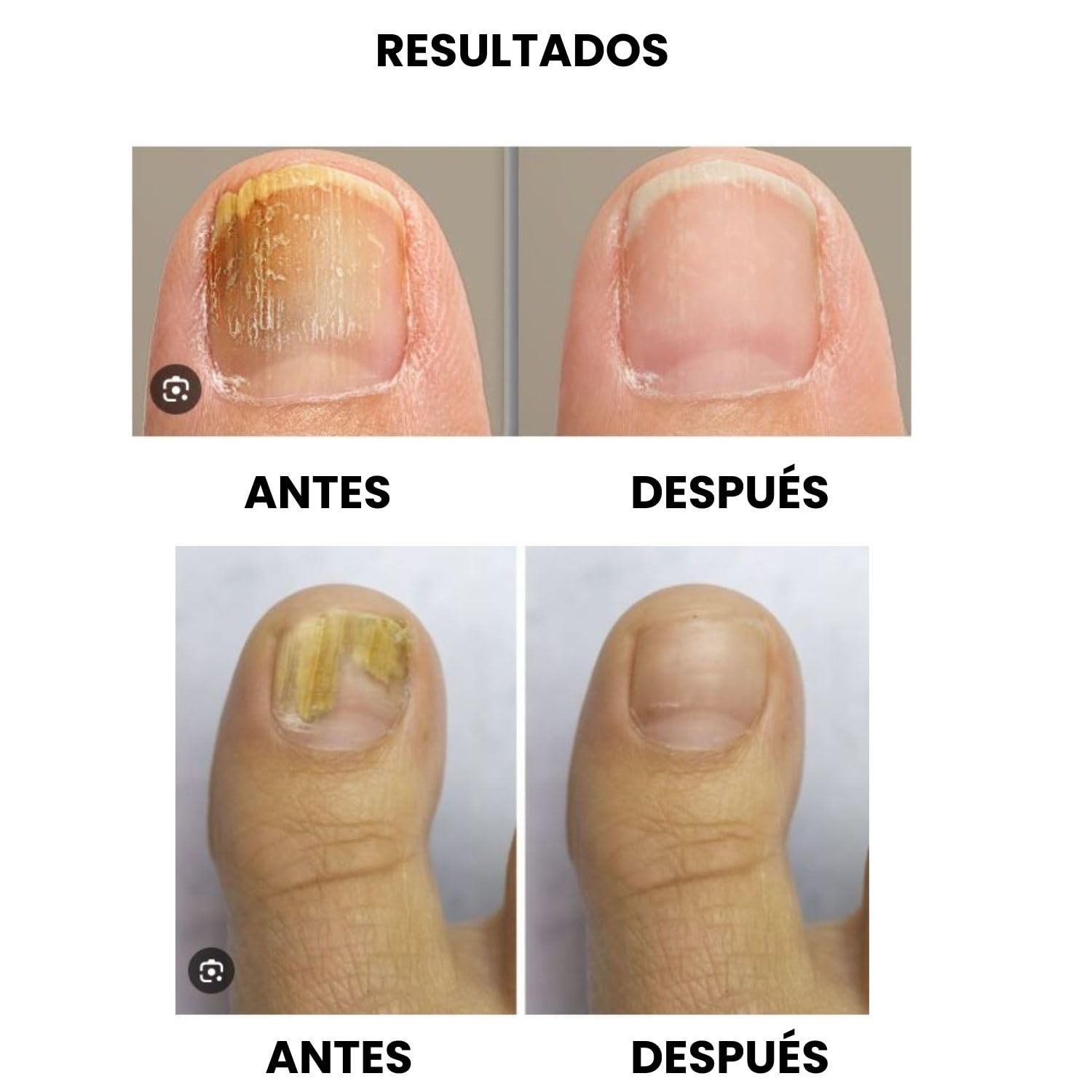 Tratamiento hongos uñas pies - Tratamiento Laser onicomicosis - antihongos - antifungico para uñas pies y manos - Eliminar micosis - potente tratamiento anti hongos - Quita hongos (Negro)
