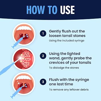 Dr. Fredericks Original Easy Tonsil Stone Remover Kit - Fast Painless Tonsillolith Removal Tool - Fight Bad Breath - Pick and Oral Irrigator - 8 Pieces