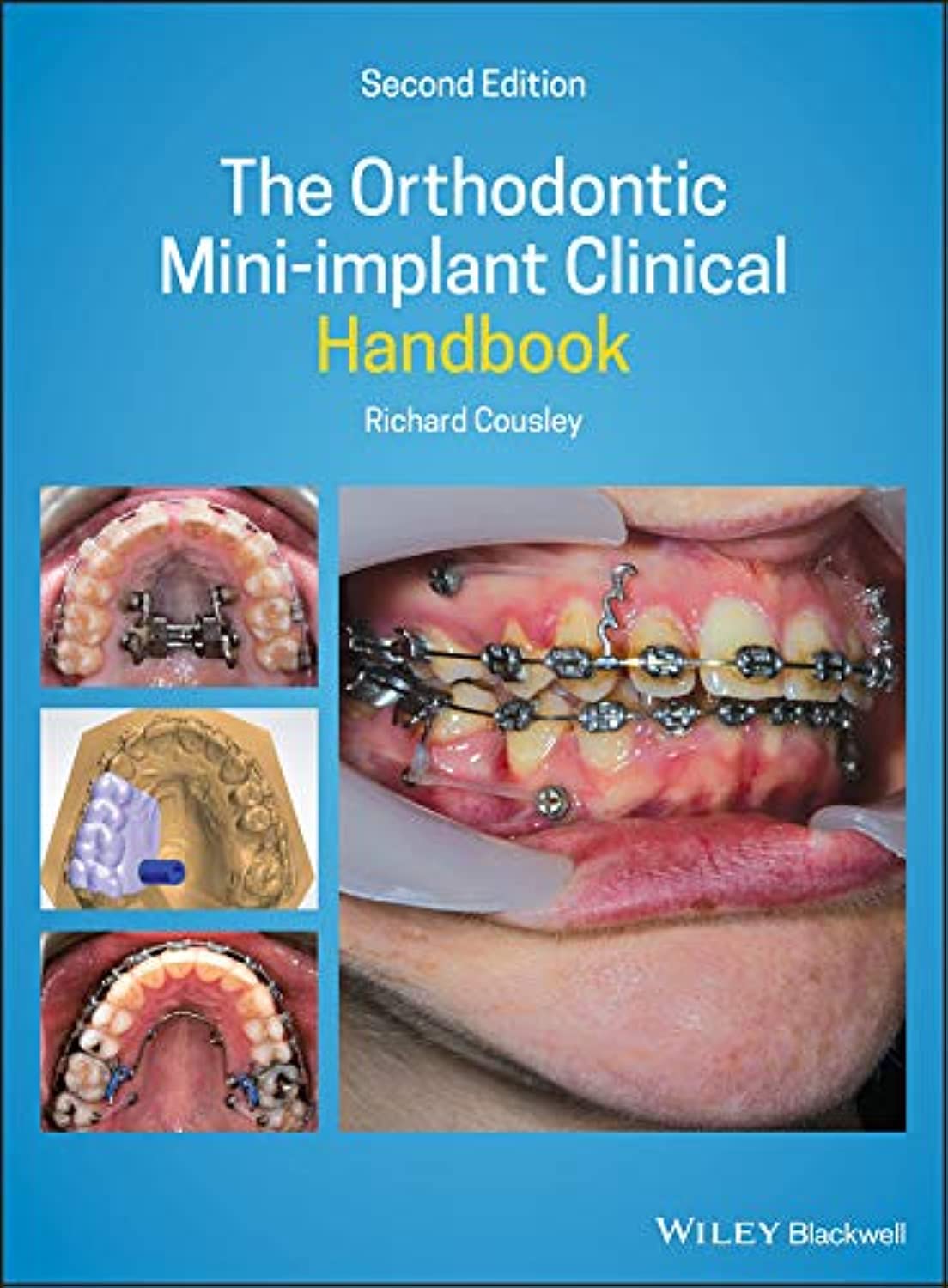 The Orthodontic Mini–implant Clinical Handbook 2nd  Edition Cousley Hardback