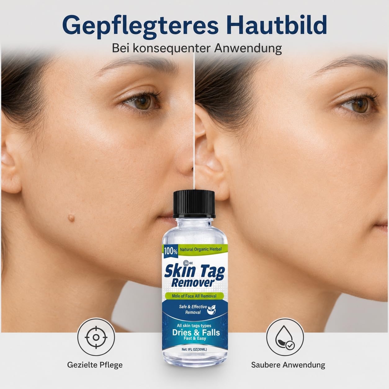 Warzenentferner, Warzen Entfernen, 30ML Warzenmittel für Hand & Fuß | Effektive Entfernung von Hautanhängseln, Füße, Hals & Weitere Bereiche Mild, Natürliche Pflanzenextrakte ohne Schmerzen