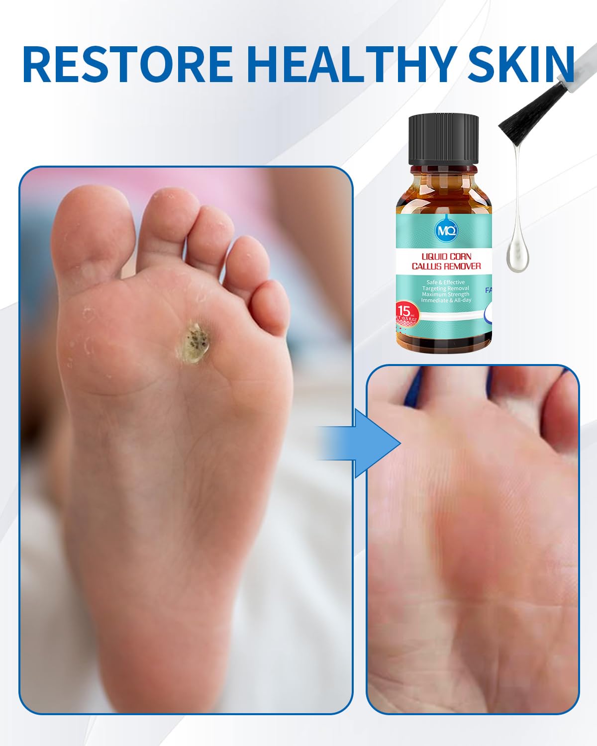 MQ 2Pcs RIMOZIONE LIQUIDA DI VERRUCHE E CALAMBRE, 15ml Rimuovi Verruca, Soluzione Contro Calli e Duroni, Rimuovi Calli, Rimuovi Verruche, Alleviamento del Dolore da Mais e Cura dei Piedi