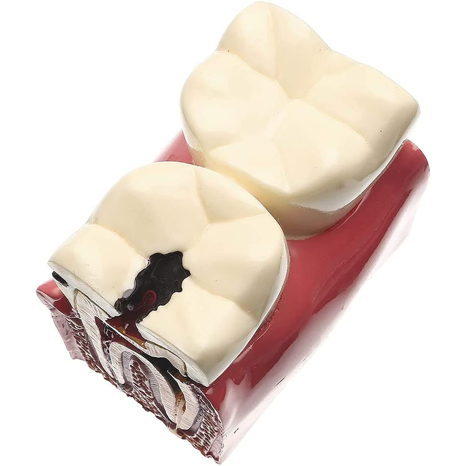 Modello di Dente con Carie Dentale, Modello di Denti Malati, Modello di Studio per pazienti odontoiatrici, Modello di Studio per confronto di Carie 6 Volte, Strumenti didattici