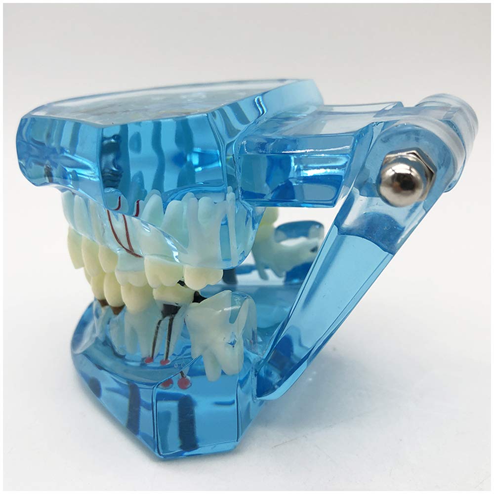 Modello di Denti da 2 Pezzi, Modello di Analisi di Studio di Impianti Dentali per Riparazione di Carie Dentale, Modello Dimostrativo per L'Insegnamento Medico, Forniture di Laboratorio