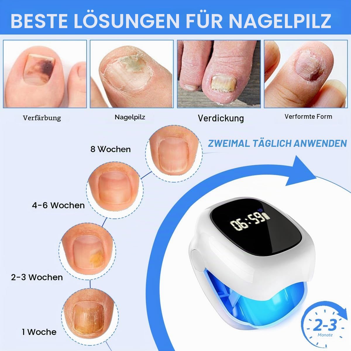Nagelpilz Lasergerät, Nagelpilz Laser Behandlungsgerät mit Zeitanzeige, Tragbares Nagelpilzlaser für Finger und Fußnägel, Nagelpilzs Laser Gerät Reinigungs, Nagelpilzs Behandlung Schnell Intensiv