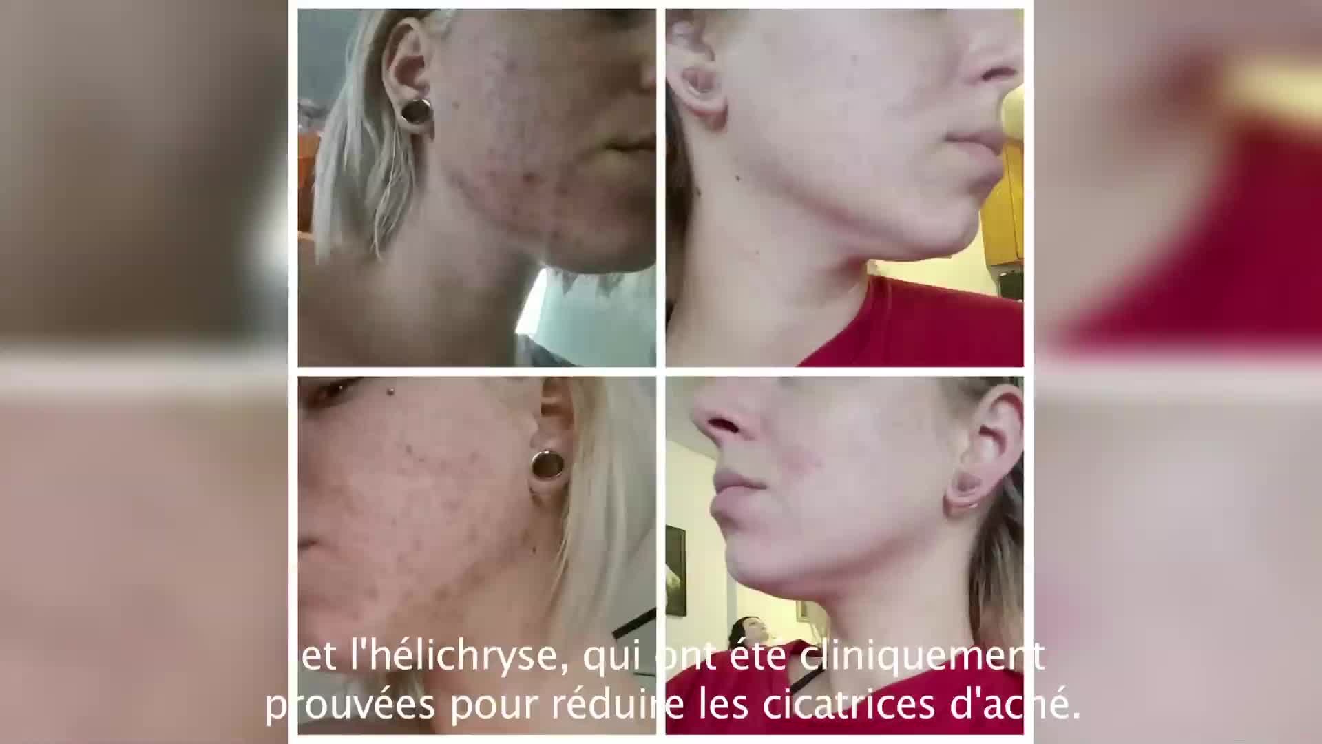 Crème Anti-acné Sévère 100 Gr - Nettoie Les Boutons, Made In France, Neuf Sous Blister
