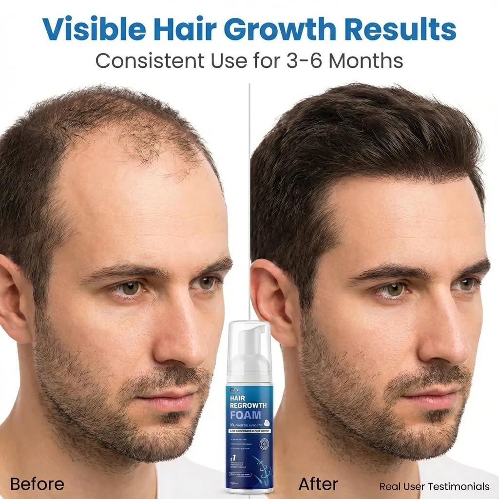 5% Minoxidil Foam for Men, Fast-Absorbing Non-Greasy Hair Regrowth Treatment for Thinning Hair & Beard, Get Stronger Thicker Fuller Hair, Clinically Proven, 2 x 2.11 Oz (2 Month Supply)