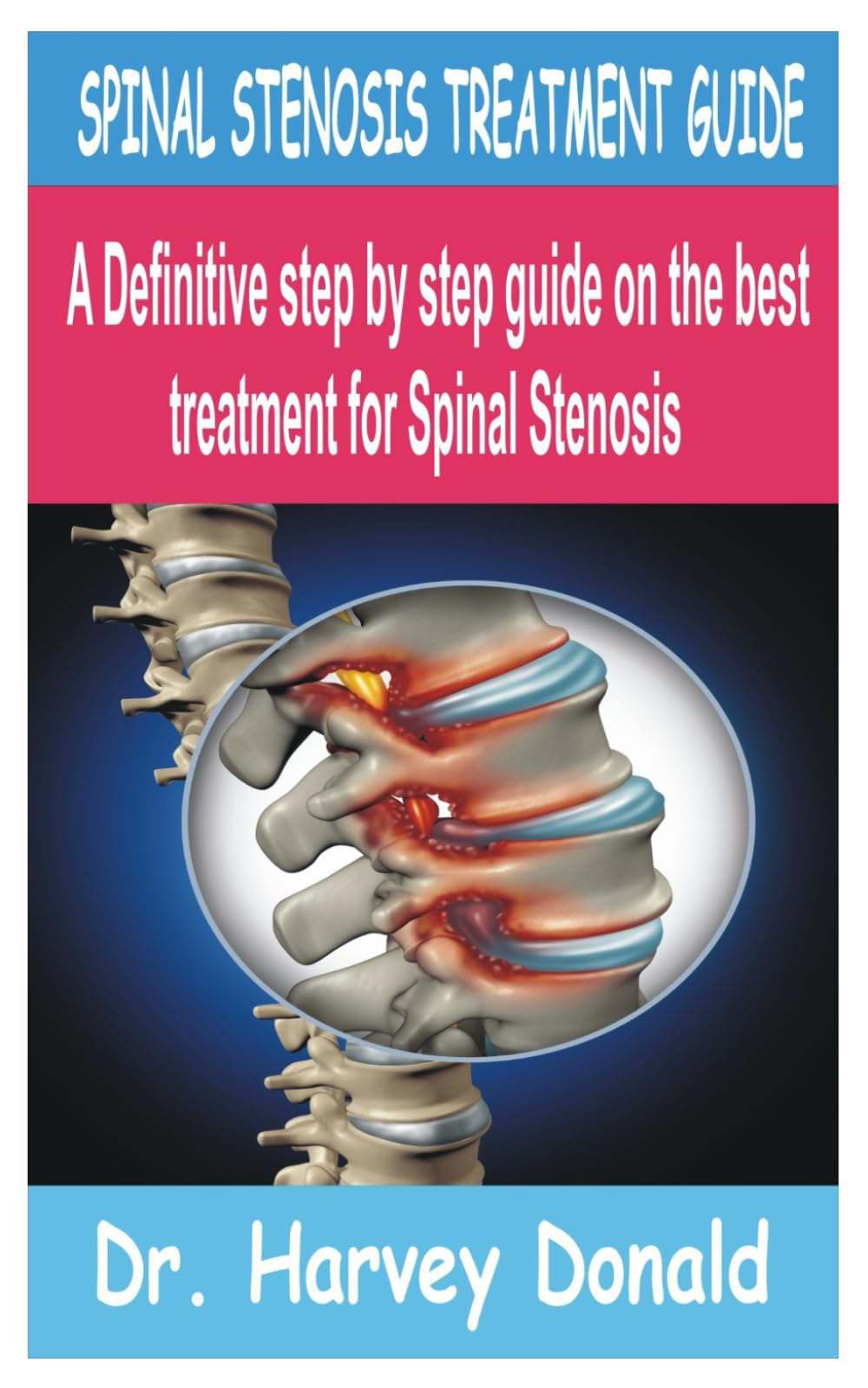SPINAL STENOSIS TREATMENT GUIDE: A Definitive step by step guide on the best treatment for Spinal Stenosis