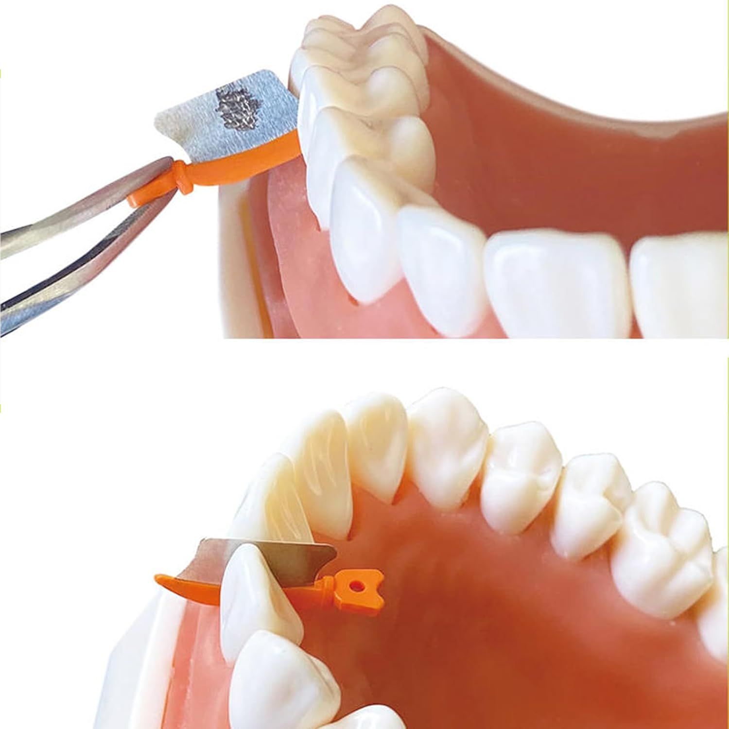 Dental Wedge Knife, Dental Interproximal Plastic Wedge, Dental Wedge Guard with Metal, Dental Plastic Wedges Orthodontic Matrix Wedges for Teeth Interproximal Area. (72PCS)