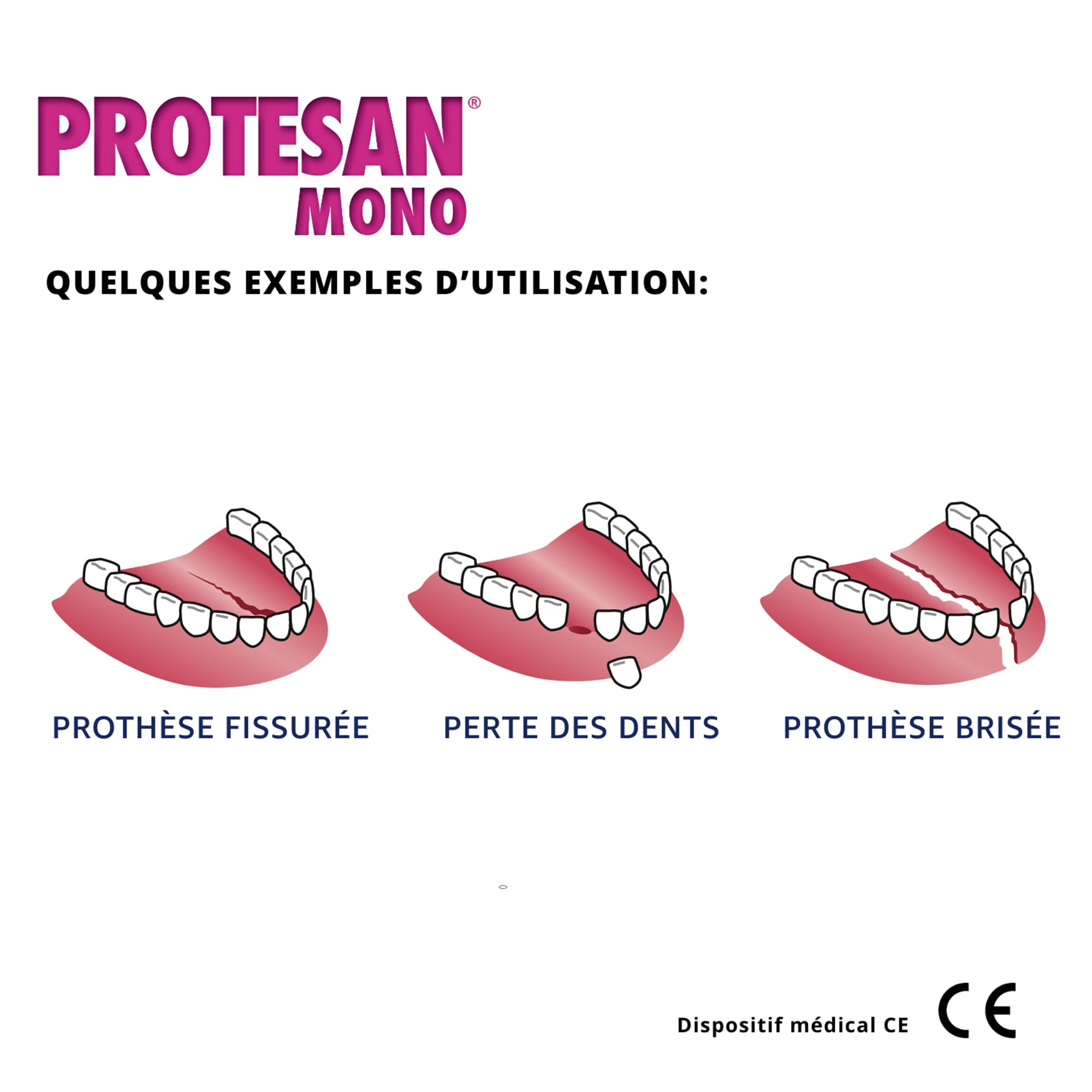 Protesan Mono - Réparateur pour dentiers cassés, fissurés ou sans une dent