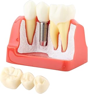 Implant Model Dental Bridges Teeth Model Dental Implant Teeth Model,Dental Model,Resin Implant Analysis Tooth Model 1pc Crown Bridge Dental Demonstration Legal Presentations for Dentist