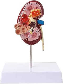 Study Model Educational Model Life Size Human Kidney Diseased Model Anatomical Anatomy Diseased Pathological Stone Organ Teaching Supplies,Medical Models SaiFei