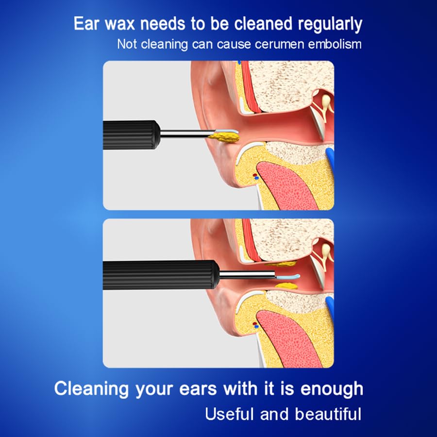 Ear Wax Removal,Earwax Remover Tool with Camera,Ear Cleaner with 6 LED Lights Otoscope for iOS & Android,Earwax Removal Kit with 7 Pcs Ear Pick(Including 5 Ear Spoon)