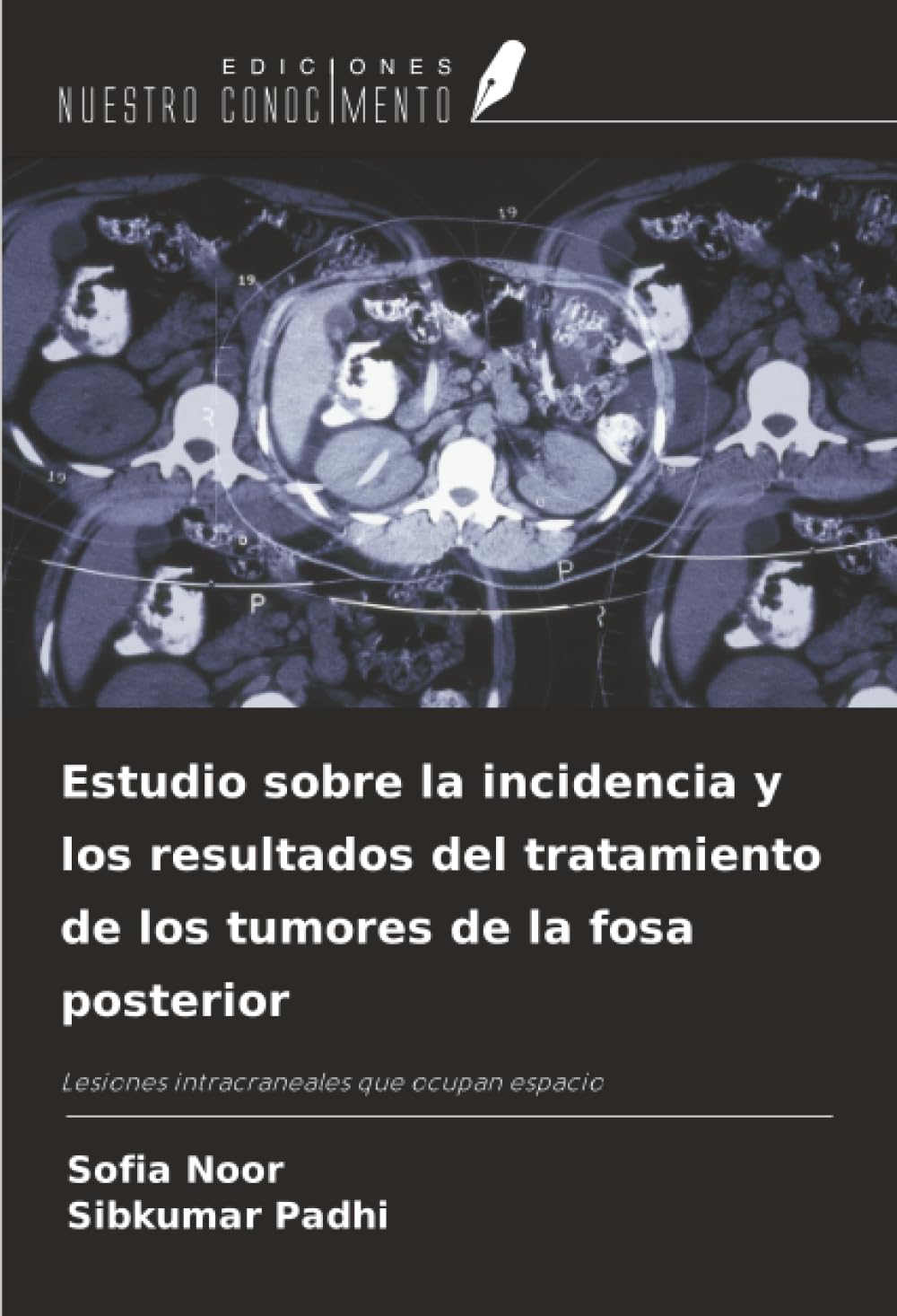 Estudio sobre la incidencia y los resultados del tratamiento de los tumores de la fosa posterior: Lesiones intracraneales que ocupan espacio