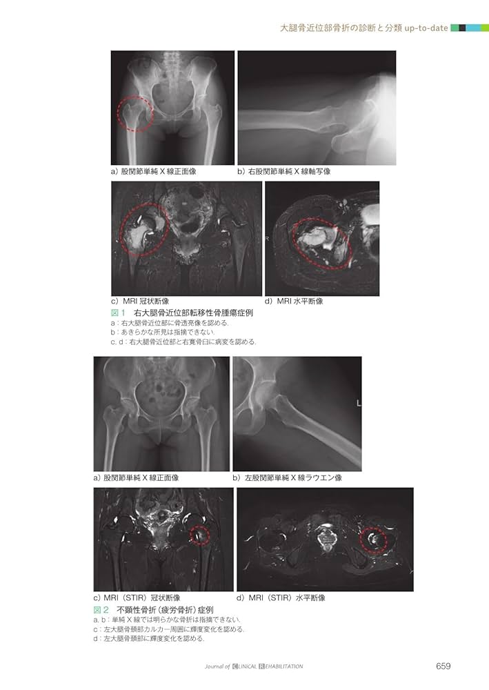 J.of CLINICAL REHABILITATION 大腿骨近位部骨折の