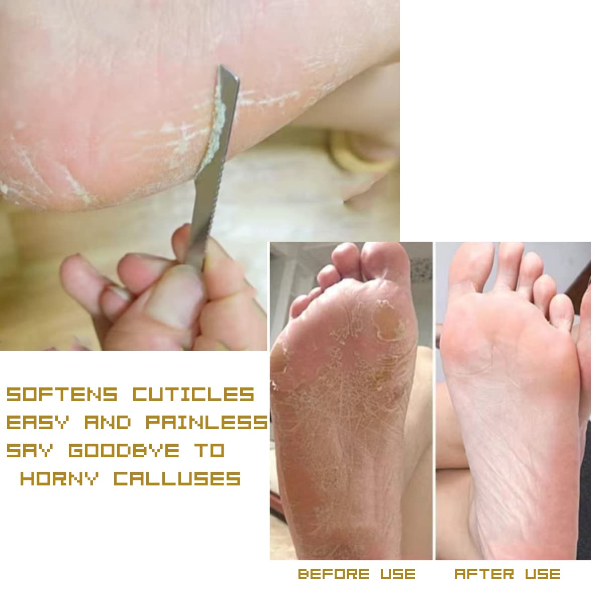 Juego de 3 cuchillos de pedicura para uñas encarnadas de acero inoxidable, raspador profesional de piel de pies, kit de hoja afilada para tratamiento de uñas, maíz, callos y paroniquia (con agujeros) 3