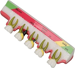 Modelo Dental de Doença Periodontal, Diferentes Estágios Claramente Exibem Melhor Compreensão do Modelo de Dentes da Doença Periodontal Resina Alta Simulação para Auxiliares de