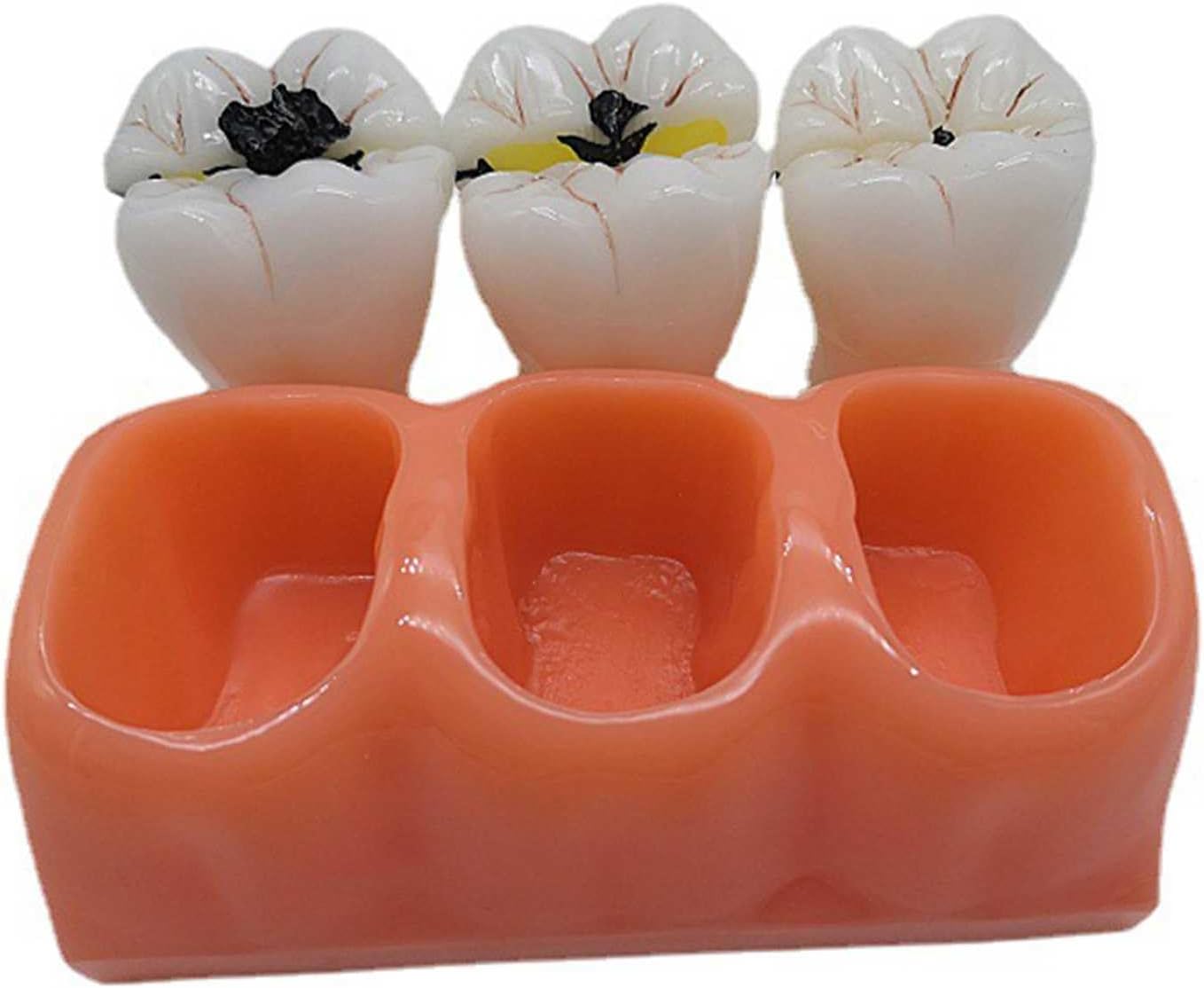 AXIKALB 歯モデル 4:1 実物大の虫歯進化モデル 医師 患者 コミュニケーション 病理学的分解