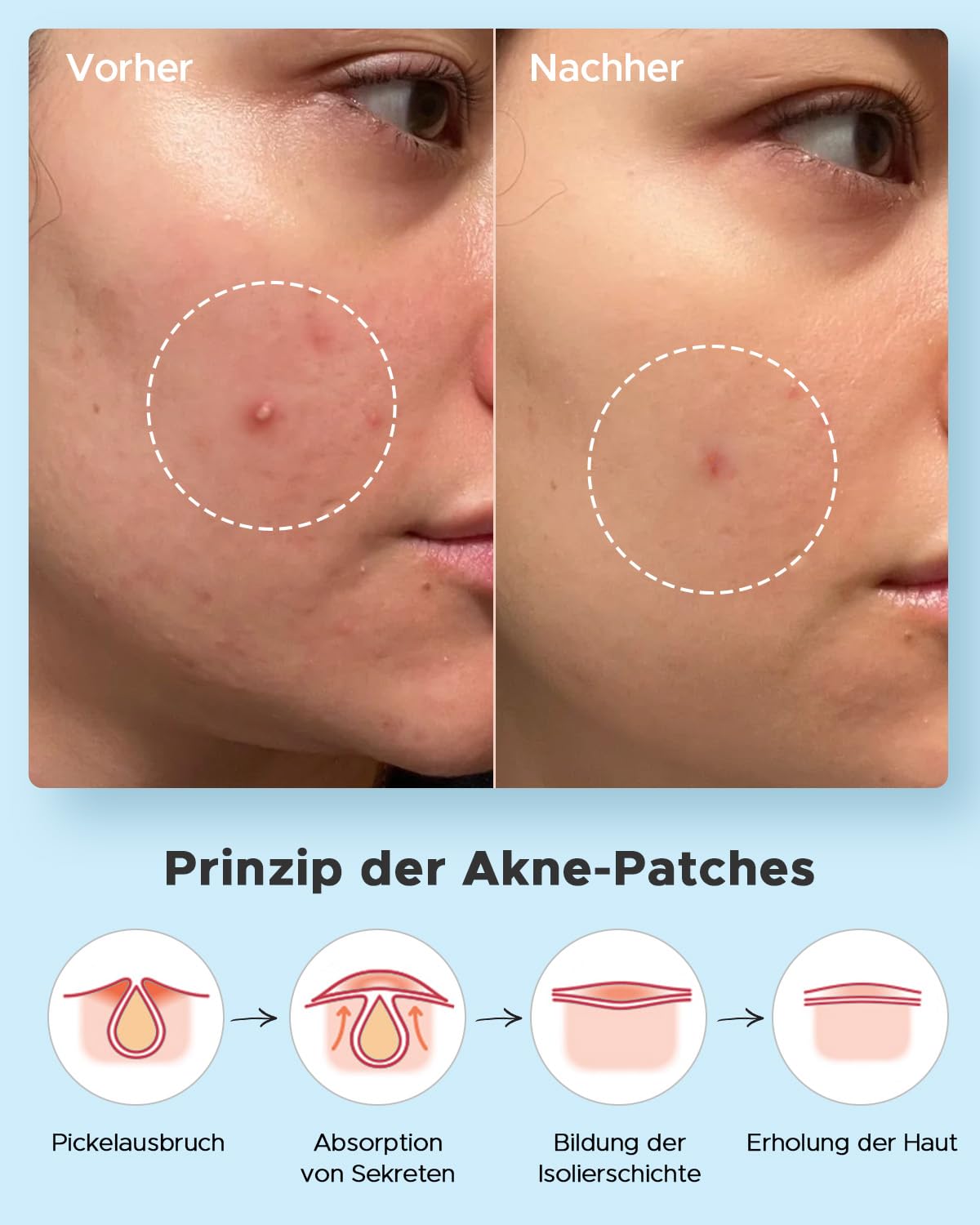 LitBear Parches de pimple, 4 tamaños para día y noche, 180 parches hidrocoloides finos y gruesos con hamamelis, aceite de árbol de té y aceite de caléndula, parches para el acné extra adherentes para