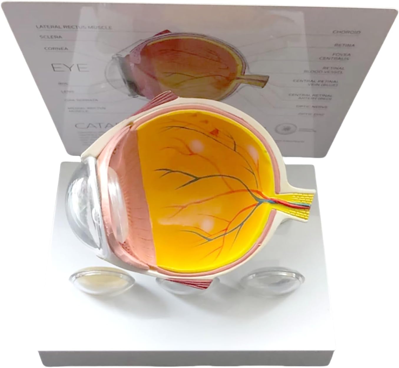 Eye Anatomy Model Realistic Pathological Model for Research Educational Use and Clinical Demonstration Glaucoma Eye