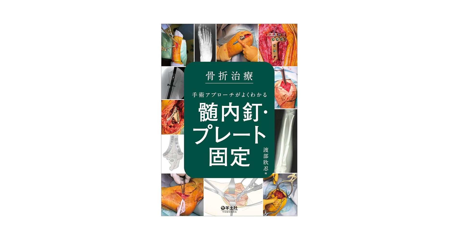 骨折治療 手術アプローチがよくわかる髄内釘・プレート固定