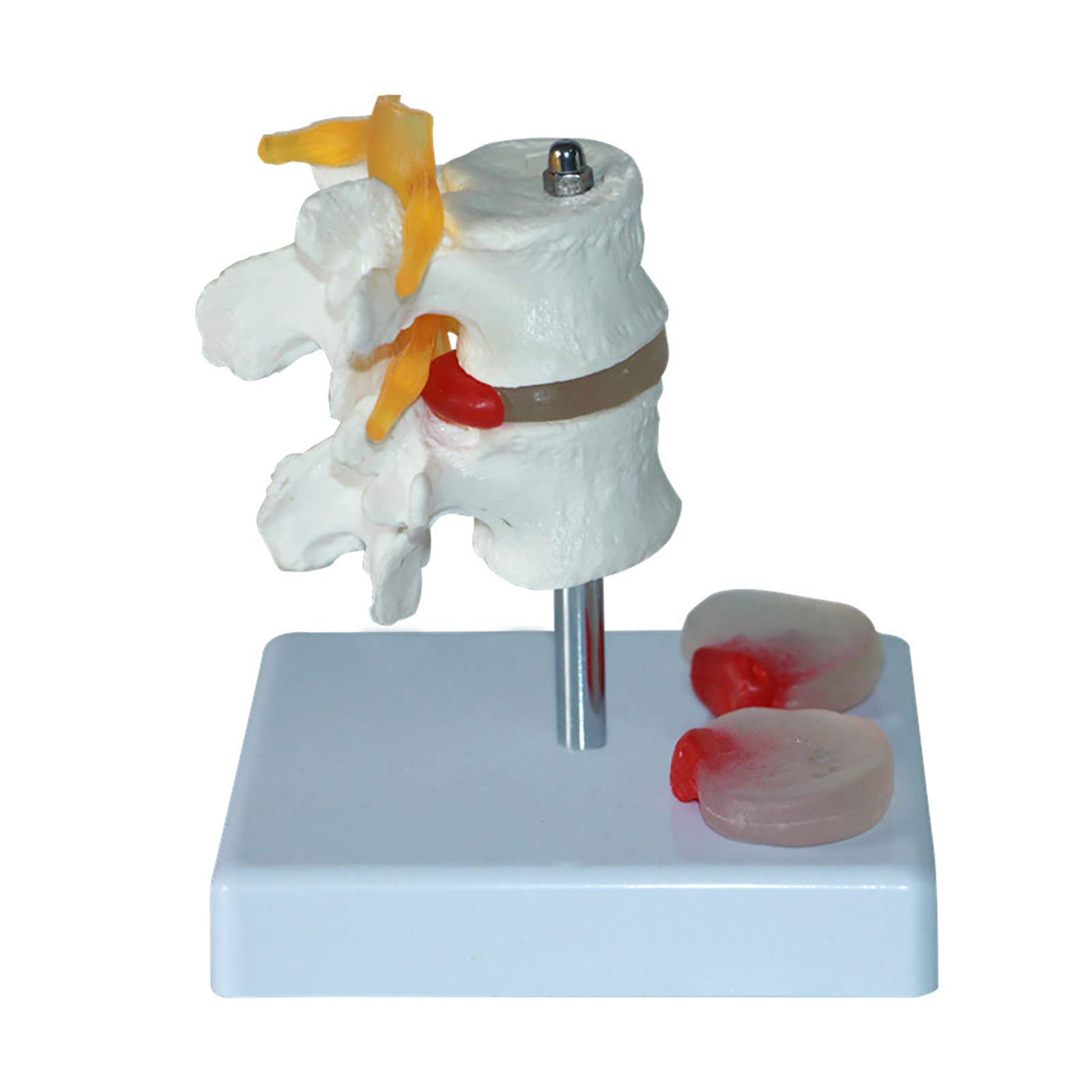 Buy Human Lumbar Spine Model,Human Anatomy Lumbar Model With 2 Diseased Discs,Lumbar Disc