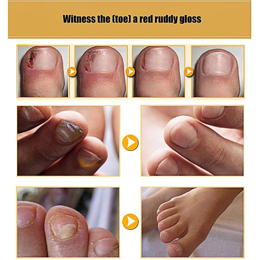 Nail Fungus Cream, Antifungal Treatment Foot Repair, Foot Fungus, Repair Protect Anti fungal