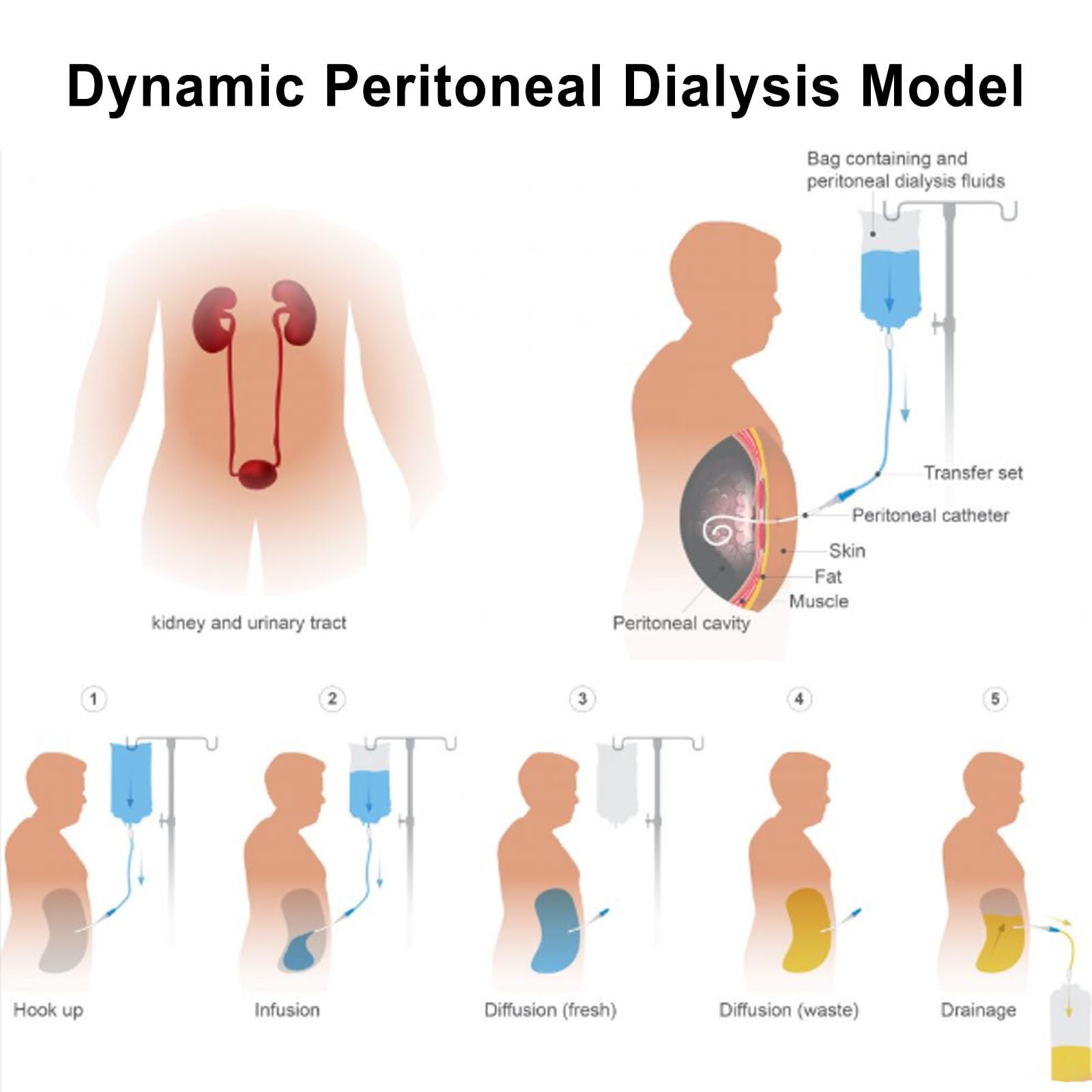 Modèle de dialyse péritonéale, mannequin de l'abdomen humain pour l'éducation médicale, démonstration et simulation avec design d'insertion de tube