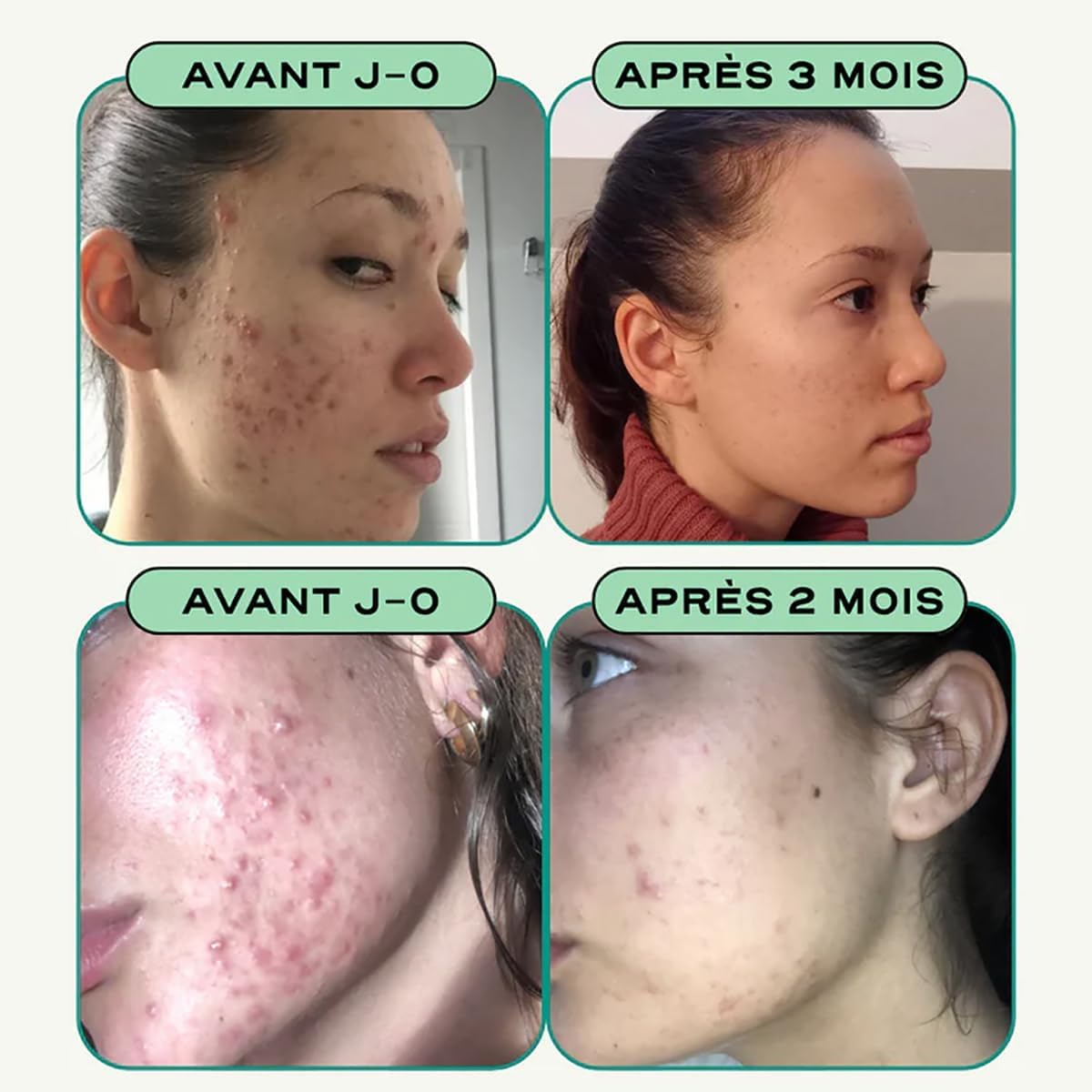 Circles CLEAR Peau Cheveux Ongles - Complément Zinc + Bardane Ortie Romarin Curcuma - Détox Peau & Équilibre Hormonal Femme - Acné Hormonale - 60 Gélules Vegan 1 Mois - Fabriqué en France