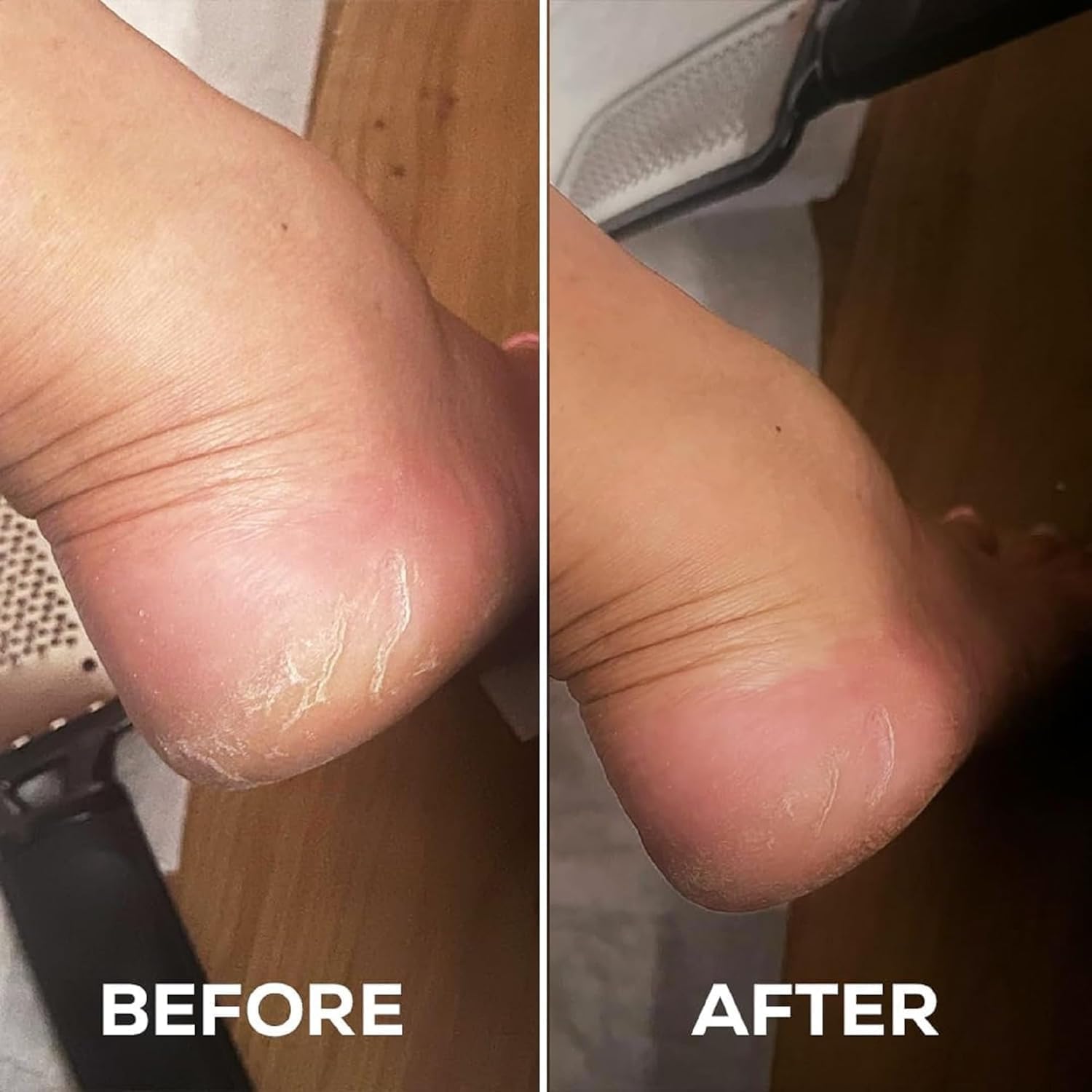 Netora Foot Peel Mask for Women & Men | Peeling & Exfoliating Foot Mask for Dry Cracked Feet, Removes Dead Skin & Calluses, Hydrates & Smooths Cracked Heels (Pack of 1) 2