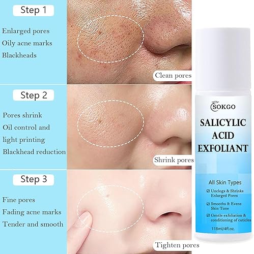 Miniatura 2 de BHA - Exfoliante líquido de ácido salicílico, tóner hidratante de ácido salicílico con vitamina E, hialuronato de sodio para puntos negros, poros