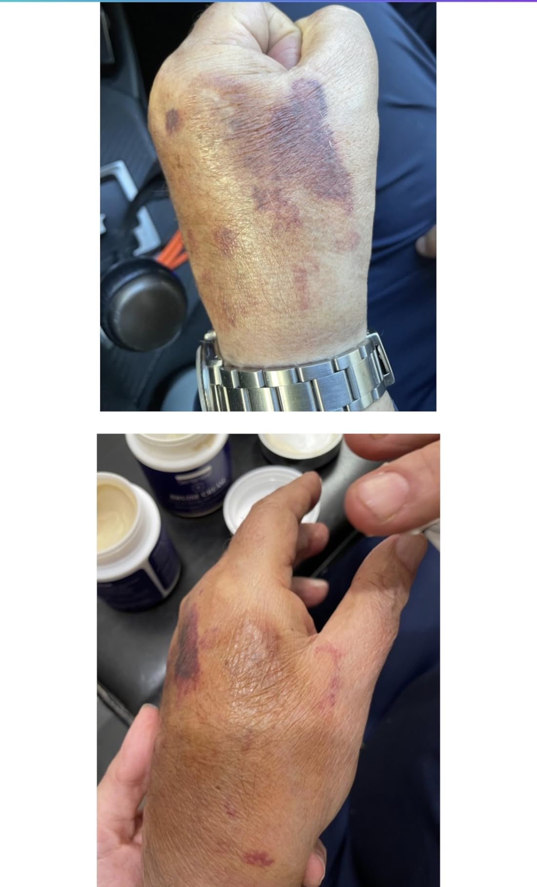 Customer bruise cream review