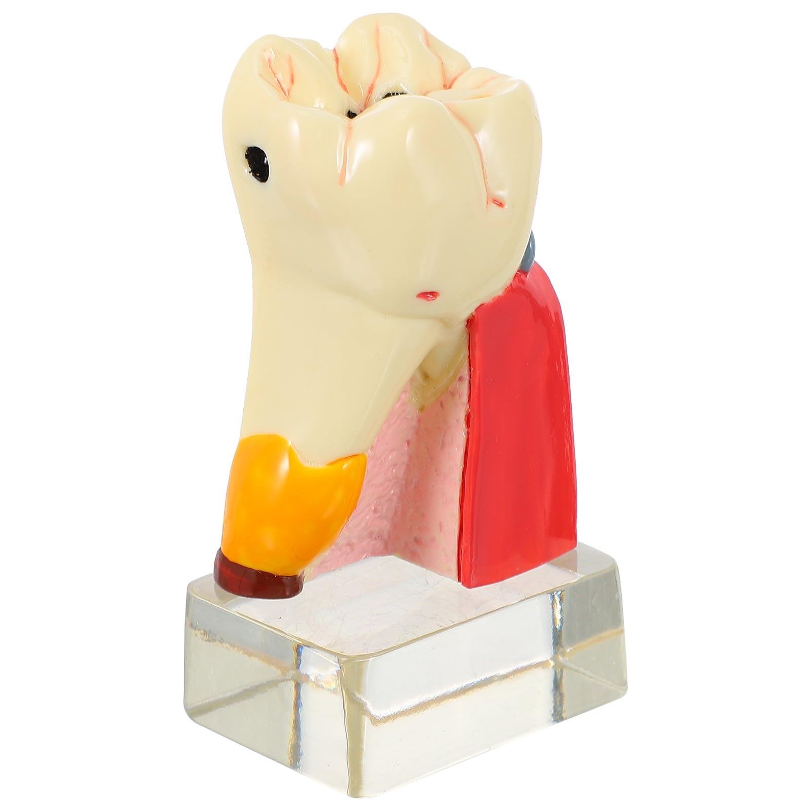 Zerodeko Modèle Anatomique de Carie Dentaire Beige en Résine Portable pour Démonstration Professionnelle des Soins Dentaires par Dentistes