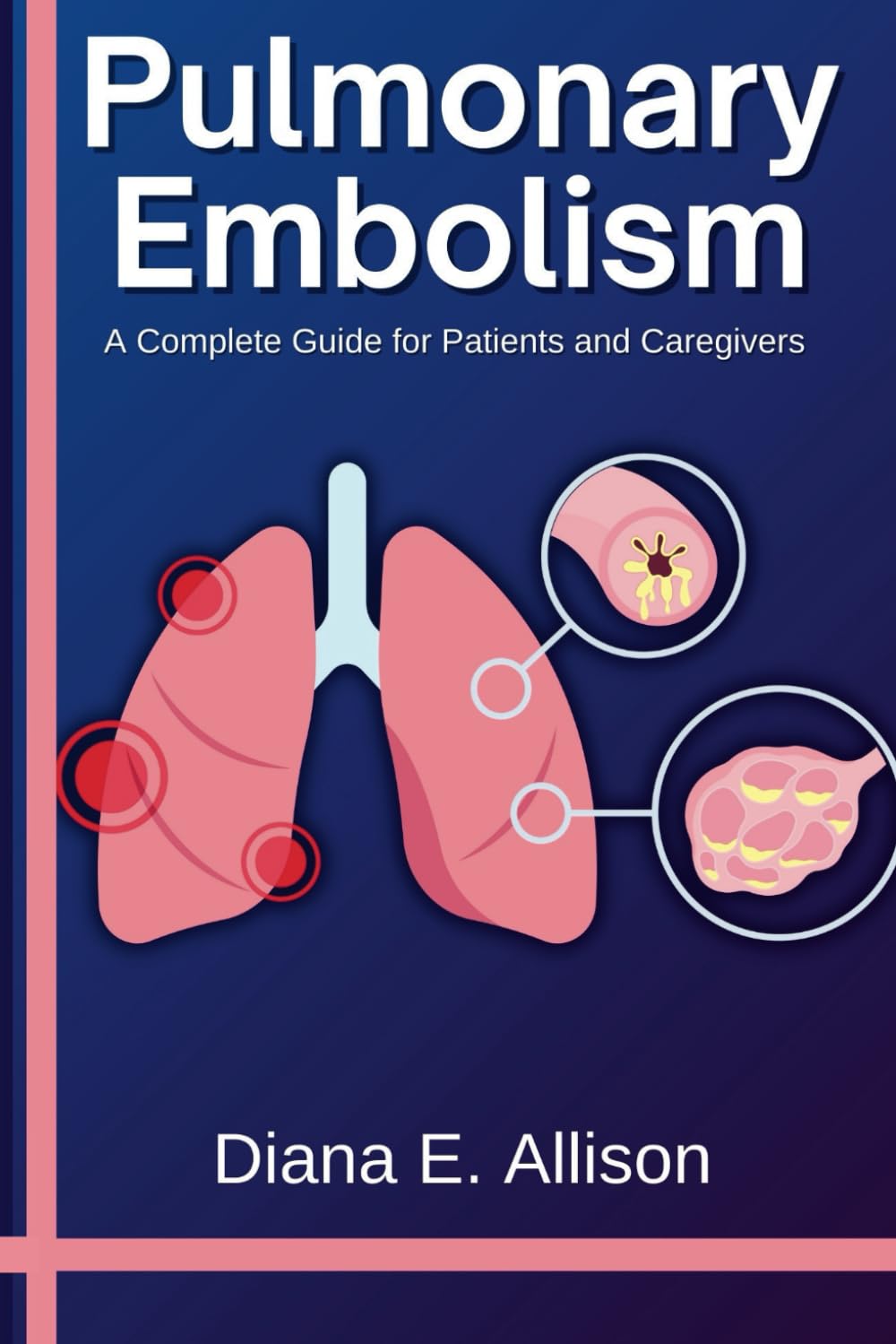 Pulmonary Embolism: A Complete Guide for Patients and Caregivers: Your Path to Understanding, Treatment, and Lasting Recovery (The Complete Health Guide Collection)