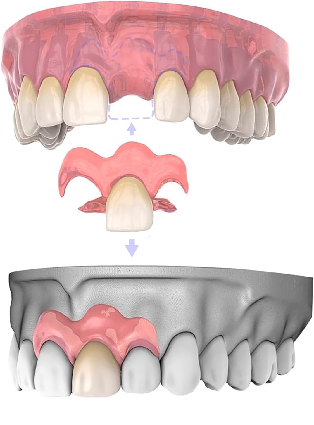 Amazon.co.jp: 4本 カスタム 入れ歯 部分 取り外し可能 Dentellea 義歯