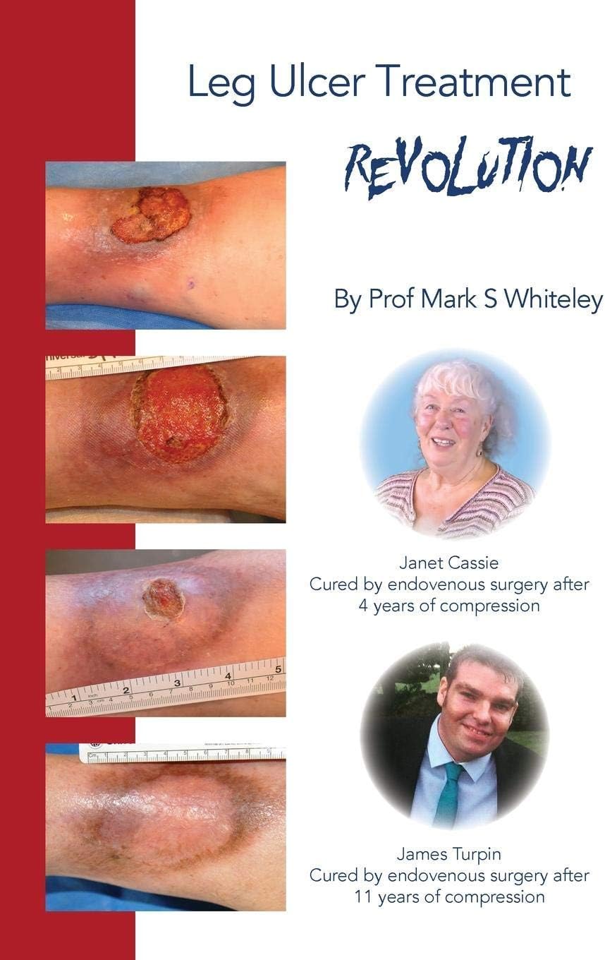 Leg Ulcer Treatment Revolution (Veins and vein treatments Book 2)