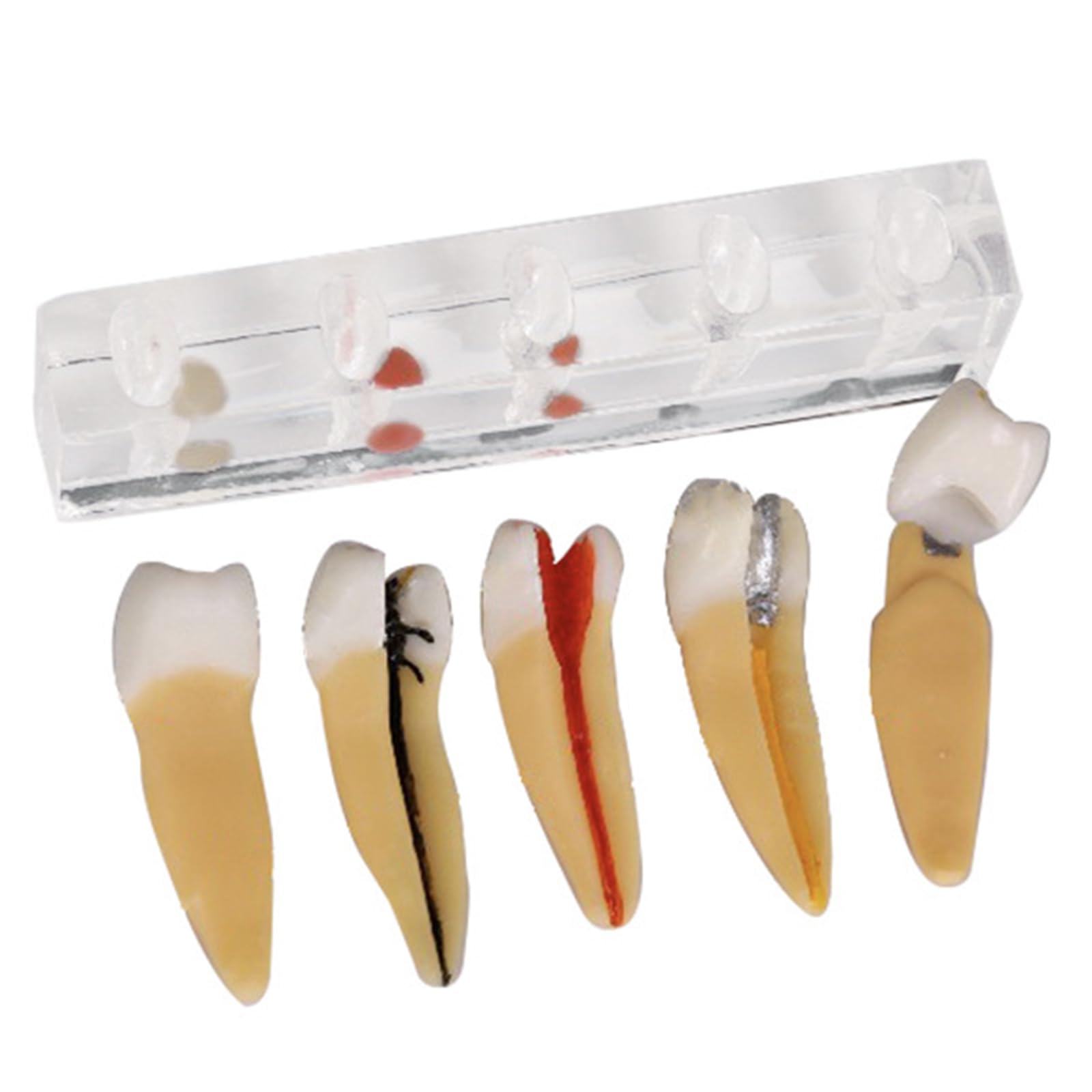 Modèle de traitement du canal radiculaire, modèle dentaire de canal radiculaire endodontique, modèle de formation à l'examen médical pour l'étude et l'enseignement